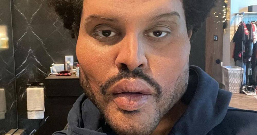 The Weeknd shows off bloated 'plastic surgery' face in
